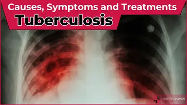 Tuberculosis article header – First Aid Article in Castle Hill
